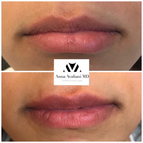 Lip Augmentation Before and After - laa18