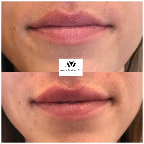 Lip Augmentation Before and After - laa19