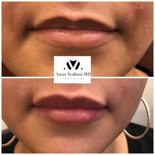 Lip Augmentation Before and After - laa2