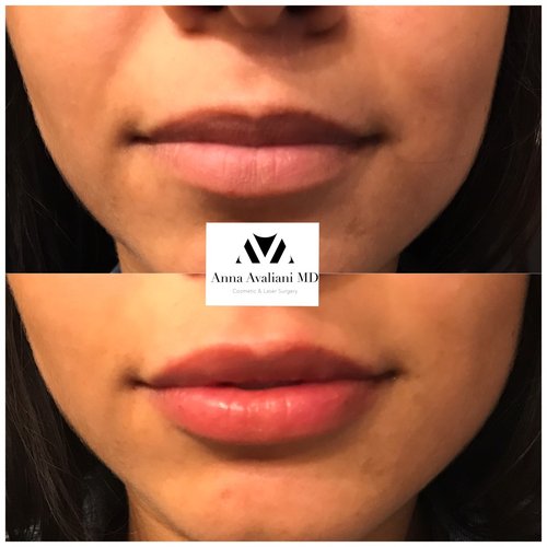 Lip Augmentation Before and After - laa20