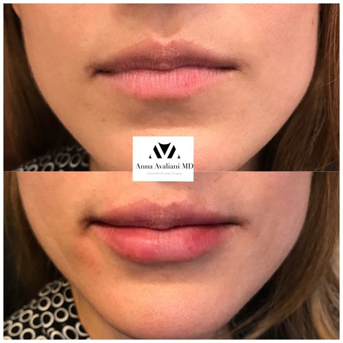 Lip Augmentation Before and After - laa21