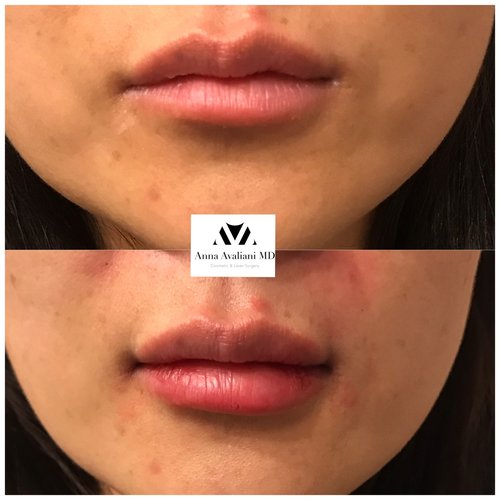 Lip Augmentation Before and After - laa22