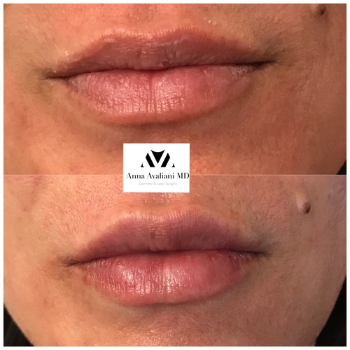 Lip Augmentation Before and After - laa23