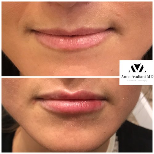 Lip Augmentation Before and After - laa3