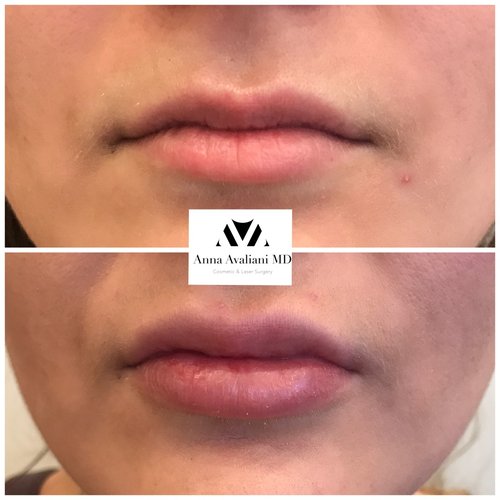 Lip Augmentation Before and After - laa4