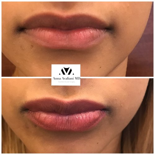 Lip Augmentation Before and After - laa5