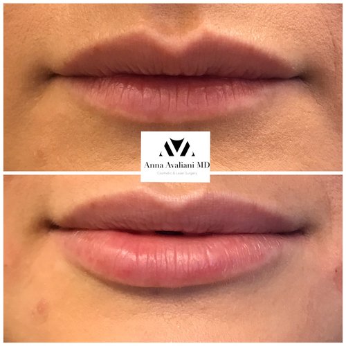 Lip Augmentation Before and After - laa6