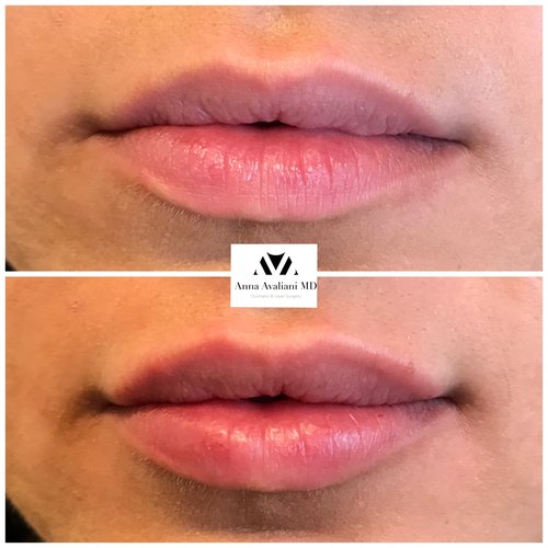 Lip Augmentation Before and After - laa7