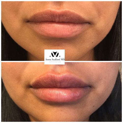 Lip Augmentation Before and After - laa8