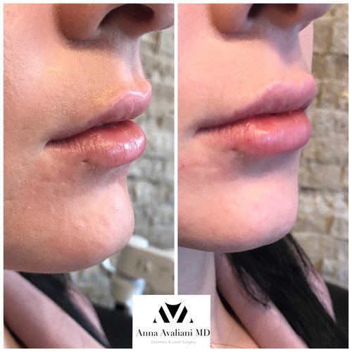 Lip Augmentation Before and After - laa9