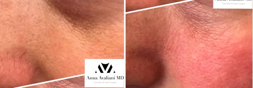Picosure / Laser Skin Rejuvenation Before and After - las1