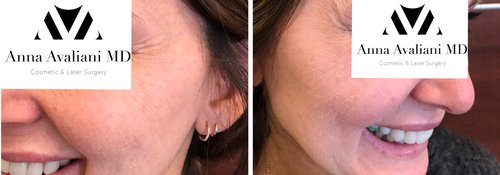 Picosure / Laser Skin Rejuvenation Before and After - las2