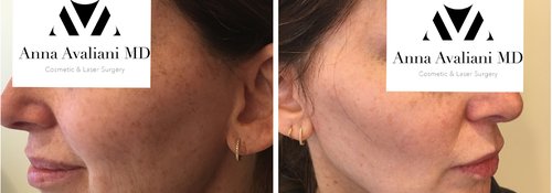 Picosure / Laser Skin Rejuvenation Before and After - las3