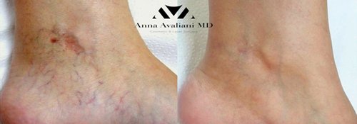 Picosure / Laser Skin Rejuvenation Before and After - lba1