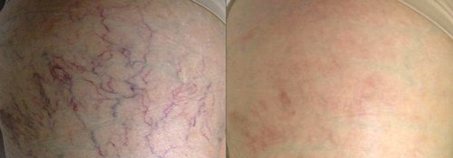 Picosure / Laser Skin Rejuvenation Before and After - lba2