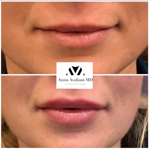 Lip Augmentation Before and After - lip1