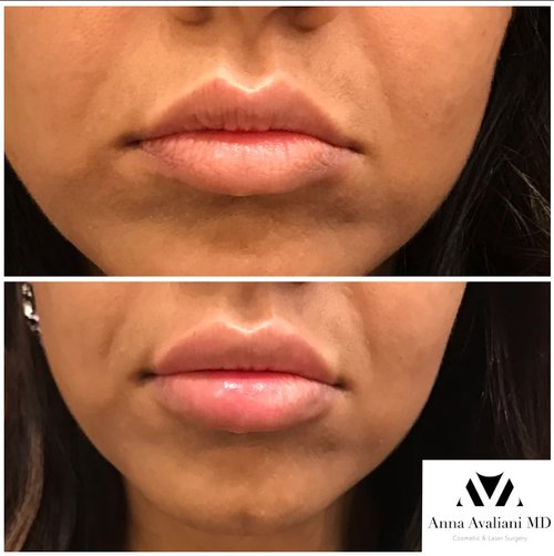 Lip Augmentation Before and After - lip2