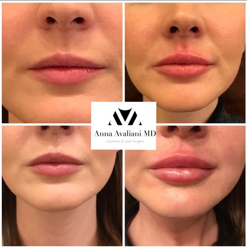 Lip Augmentation Before and After - lip3