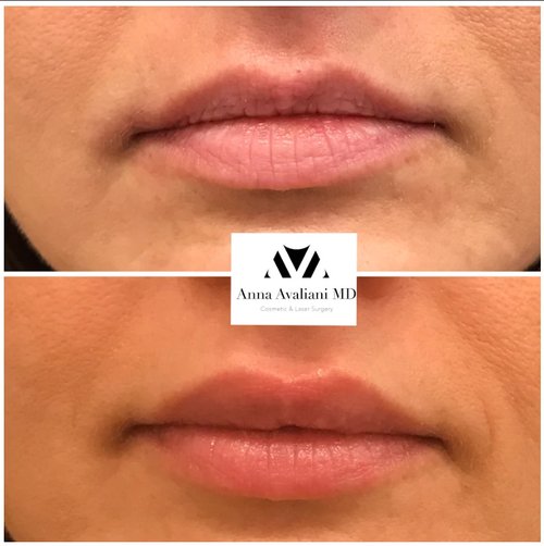 Lip Augmentation Before and After - lip4