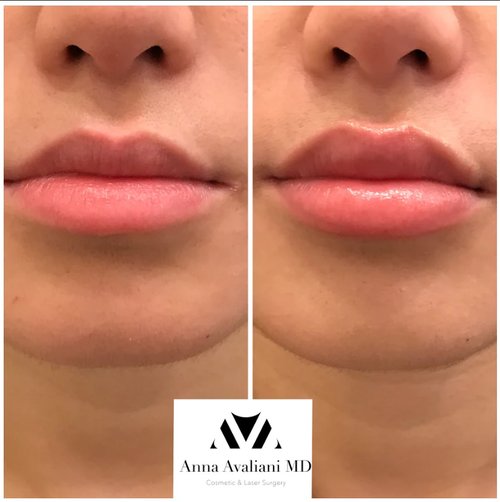 Lip Augmentation Before and After - lip5