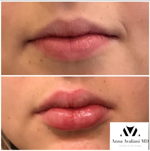 Lip Augmentation Before and After - lip6