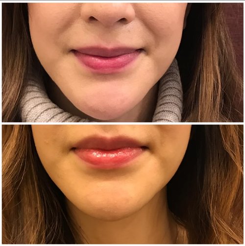 Lip Augmentation Before and After - lip7