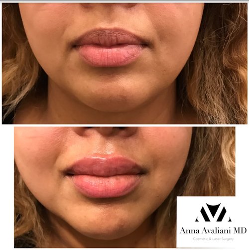 Lip Augmentation Before and After - lip8