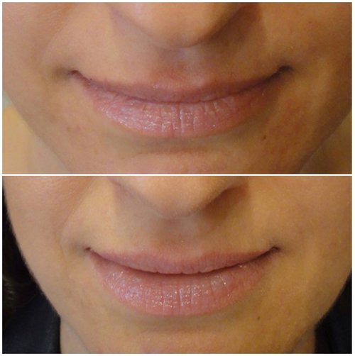 Lip Augmentation Before and After - lip88