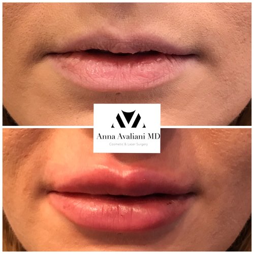 Lip Augmentation Before and After - lp1-1