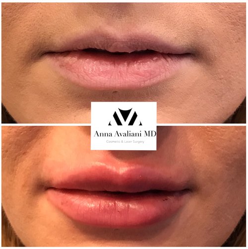 Lip Augmentation Before and After - lp1