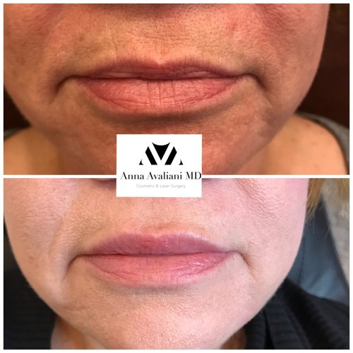 Lip Augmentation Before and After - lp10
