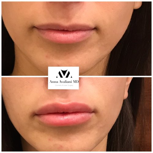 Lip Augmentation Before and After - lp2-1