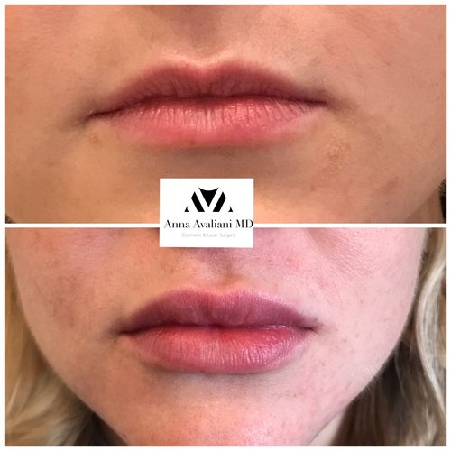 Lip Augmentation Before and After - lp3-1