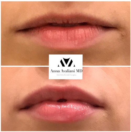 Lip Augmentation Before and After - lp3