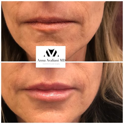 Lip Augmentation Before and After - lp4-1