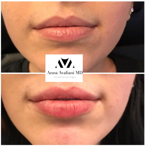 Lip Augmentation Before and After - lp4
