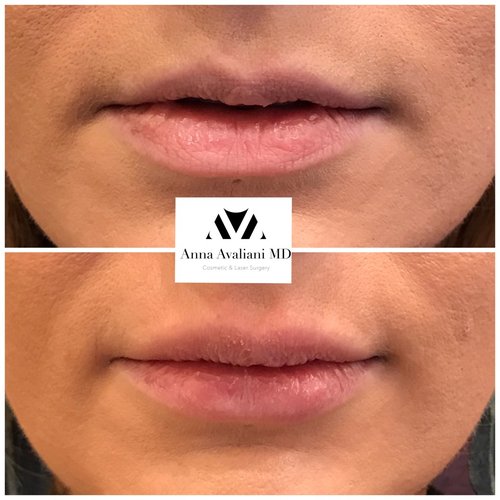 Lip Augmentation Before and After - lp5-1