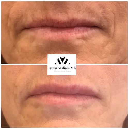 Lip Augmentation Before and After - lp6-1