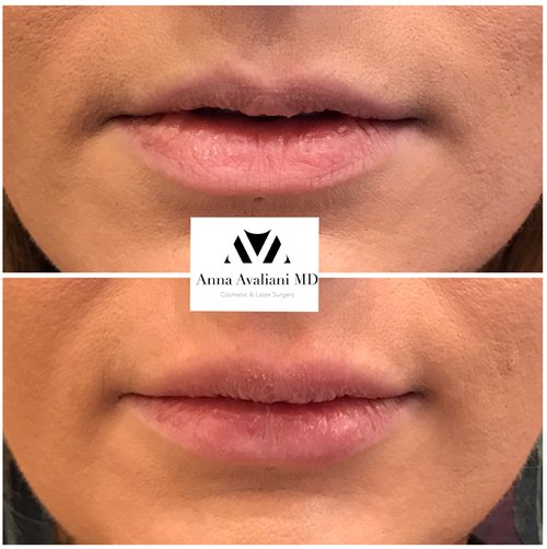 Lip Augmentation Before and After - lp6