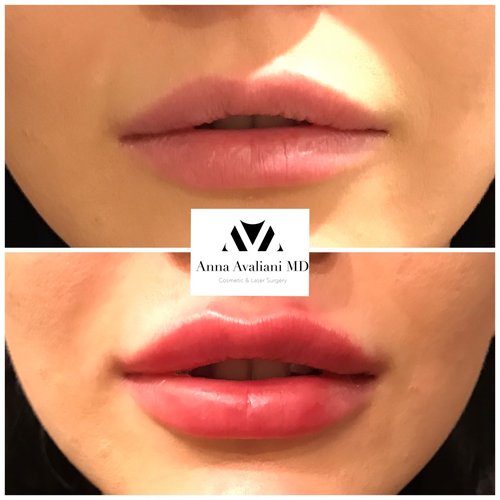 Lip Augmentation Before and After - lp7