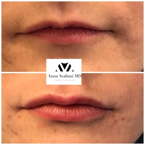 Lip Augmentation Before and After - lp8