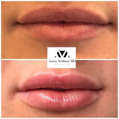 Lip Augmentation Before and After - lp9
