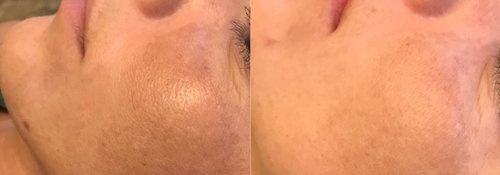 Picosure / Laser Skin Rejuvenation Before and After - lr1