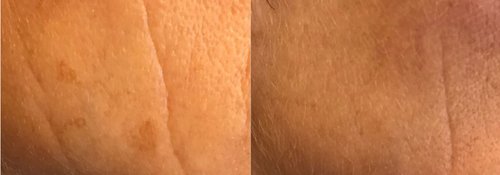 Picosure / Laser Skin Rejuvenation Before and After - lr10