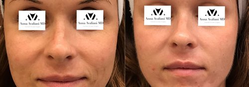 Picosure / Laser Skin Rejuvenation Before and After - lr11