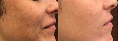 Picosure / Laser Skin Rejuvenation Before and After - lr12