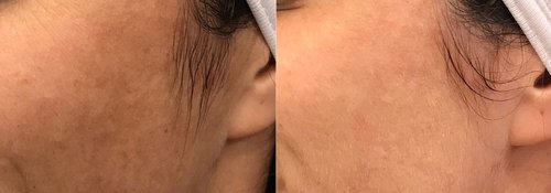 Picosure / Laser Skin Rejuvenation Before and After - lr13