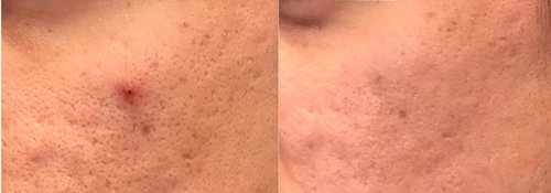 Picosure / Laser Skin Rejuvenation Before and After - lr14