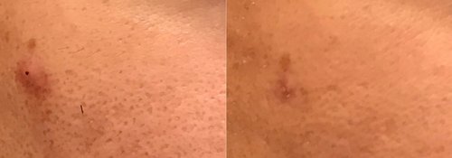 Picosure / Laser Skin Rejuvenation Before and After - lr15