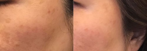 Picosure / Laser Skin Rejuvenation Before and After - lr16